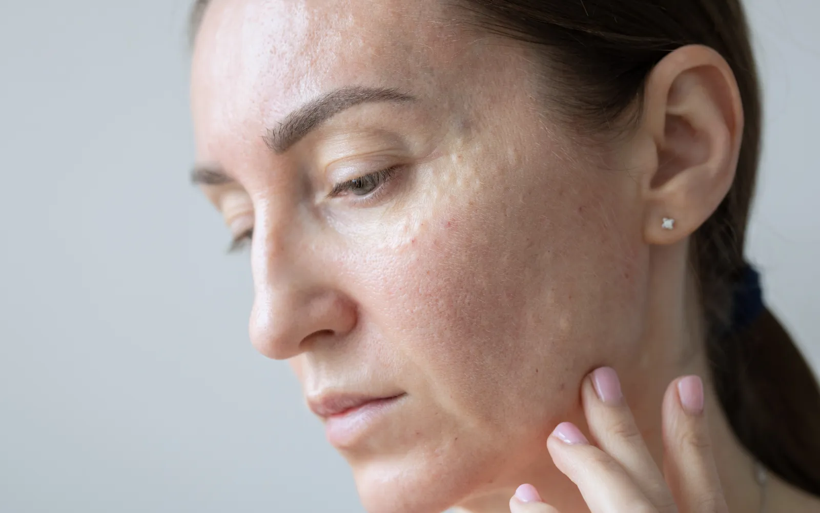 A woman with eczema on her face, representing one of the common mold exposure symptoms Spotless sees